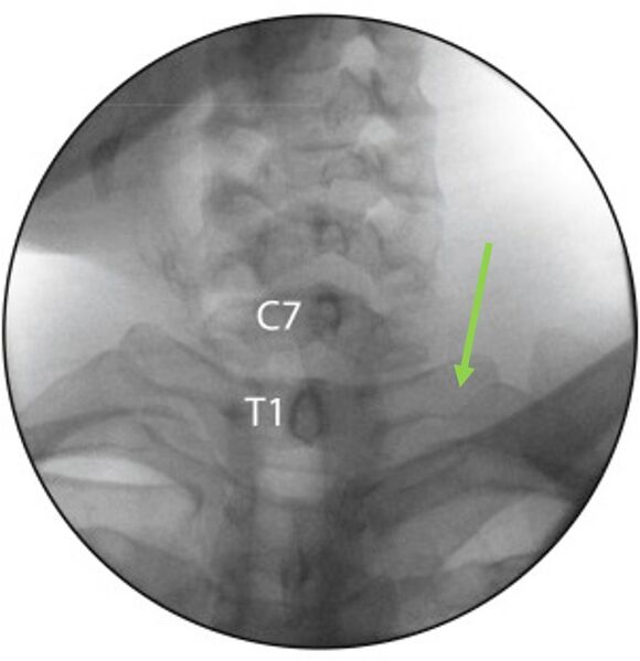 File:Cervicothoracic junction AP fluoroscopy.jpg