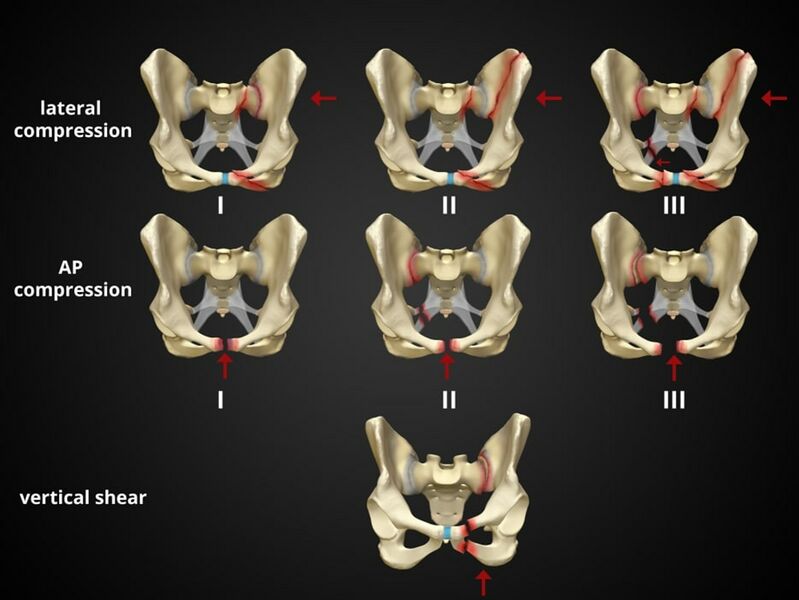 File:Pelvic fracture patterns.jpg
