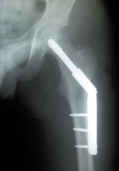 File:Femoral head compression strew intertrochanteric fracture.jpg