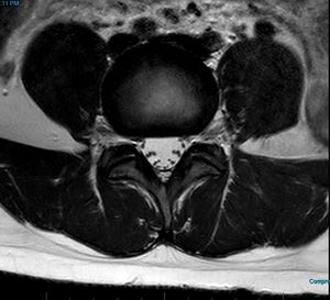 MRI T2 Lumbar Spine L4-L5 Transarticular Axial.jpg