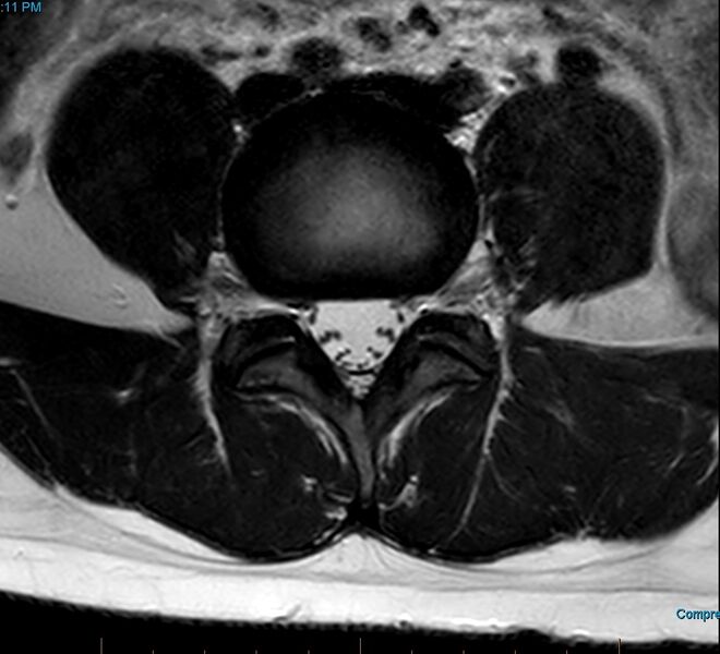 File:MRI T2 Lumbar Spine L4-L5 Transarticular Axial.jpg