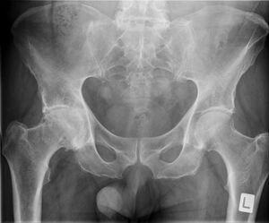 Hip x-ray frontal advanced osteoarthritis.jpeg