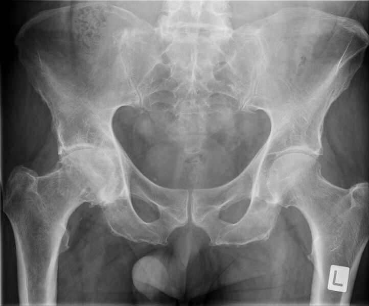 File:Hip x-ray frontal advanced osteoarthritis.jpeg