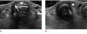 Sagittal band tear ultrasound.jpg