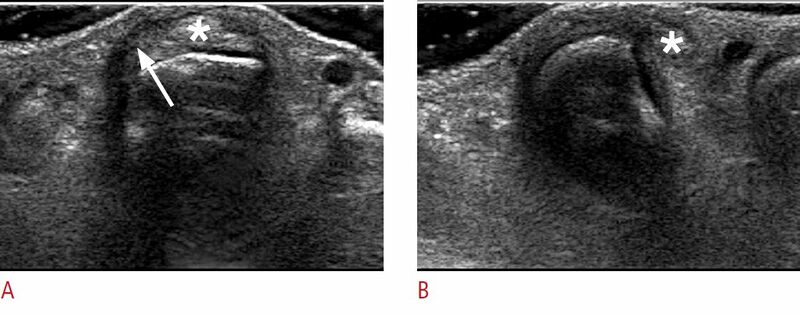 File:Sagittal band tear ultrasound.jpg