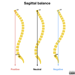Sagittal-balance-spine.png