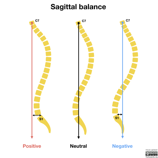 File:Sagittal-balance-spine.png