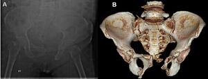 Pelvic fracture CT.jpg