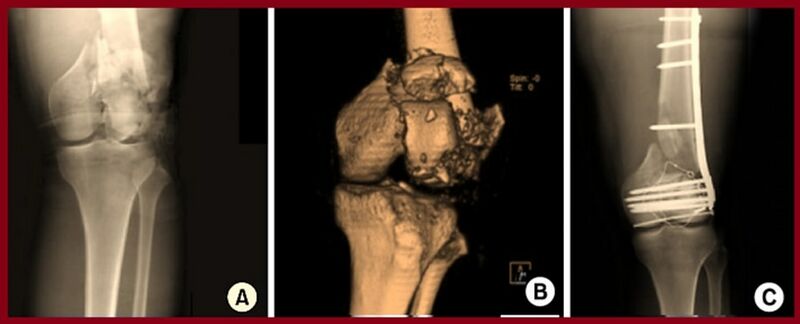 File:Distal femur fracture ORIF.jpg