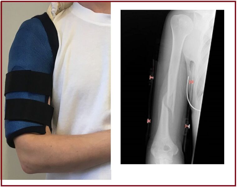 File:Humerus fracture bracing.jpg