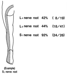 Proportion having band like deficits. L4 dorsal ramus: 42% have a cutaneous distribution, L5 dorsal ramus: 44%, and S1 dorsal ramus: 92%.