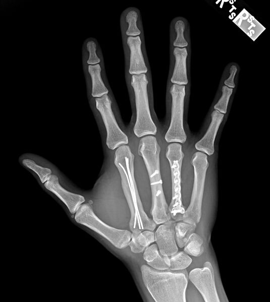 File:Metacarpal fracture surgery.jpg