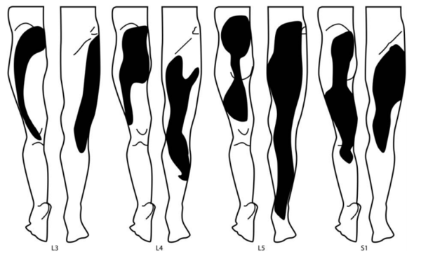 Referred pain patterns from noxious stimulation of the lumbar interspinous ligaments. Kellgren 1939.