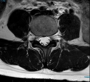 MRI T2 Lumbar Spine L4 Subpedicular Axial.jpg