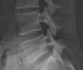 Zoomed in lateral view of L4-5 zygapophyseal joint