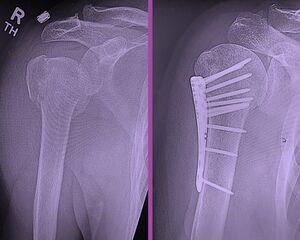 Proximal humeral fracture and fixation.jpg