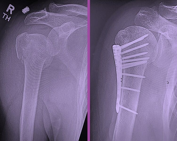 File:Proximal humeral fracture and fixation.jpg
