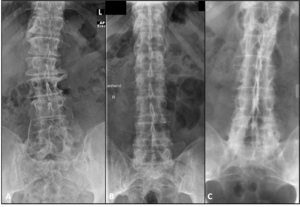 Osteophytosis DISH and AS lumbar AP.png