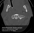 Atlantoaxial dislocation