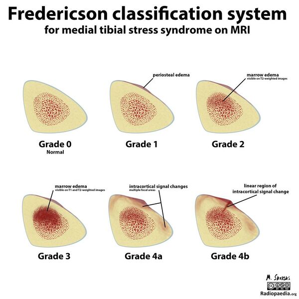 File:Medial tibial stress Fredericson grading.jpg