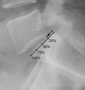 Spondylolisthesis measurement on X-ray.png