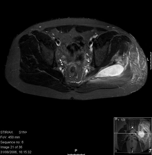 File:Pyomyositis MRI.jpg
