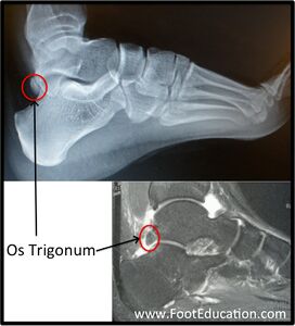 Figure 4: Os Trigonum (circled in red) on Plain Ankle X-ray (Top) and MRI (Bottom).
