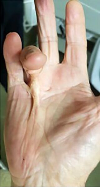 File:Dupuytrens contracture.jpg