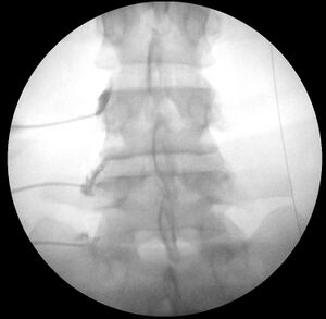 Lumbar medial branch blocks fluoroscopy left L3-5.jpg