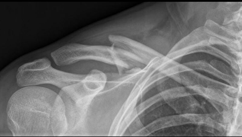 File:Midshaft clavicle fracture.jpg