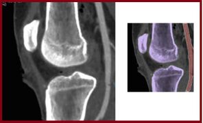 Figure 4: Angiography (left) demonstrates the proximity of the popliteal artery to the bones of the knee. As see in the annotated image (right) the popliteal artery (appropriately in red) is just posterior to the knee joint. (Modified from Cooper N, Roshdy M, Sciarretta JD, Kaufmann C, Duncan S, Davis J, Macedo FI. Multidisciplinary team approach in the management of popliteal artery injury. J Multidiscip Healthc. 2018;11:399-403)