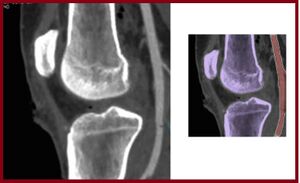 Popliteal artery knee xr.jpg