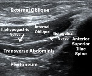 Oblique ultrasound image demonstrating the acoustic shadow of the anterior superior iliac spine and the muscles layers and facial plane containing the ilioinginal and iliohypogastric nerves.