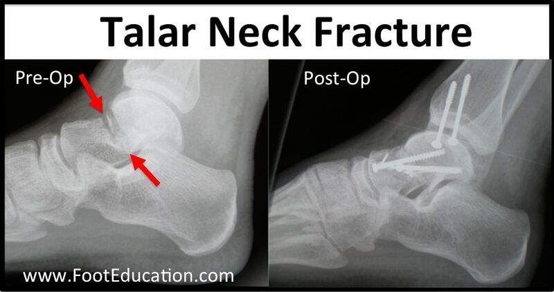 File:Talar neck fracture pre and post op xrays.jpg