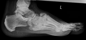 Charcot arthropathy affecting the tarsometatarsal joint Lateral.jpg
