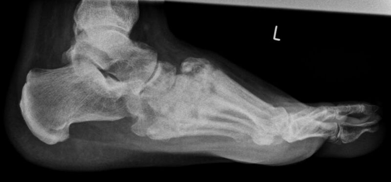 File:Charcot arthropathy affecting the tarsometatarsal joint Lateral.jpg
