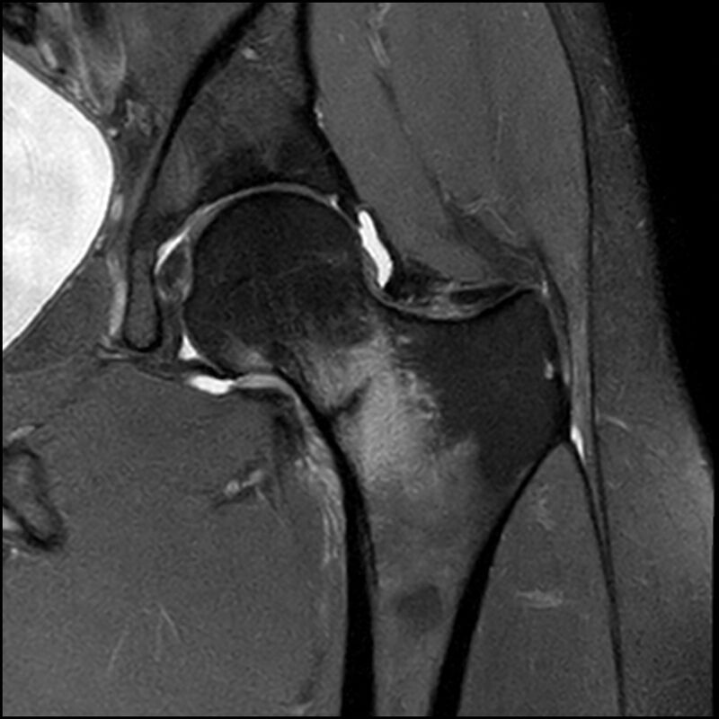 Femoral Neck Stress Fracture Wikimsk 6694