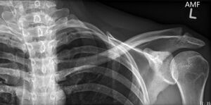 Distal clavicle osteolysis.jpg