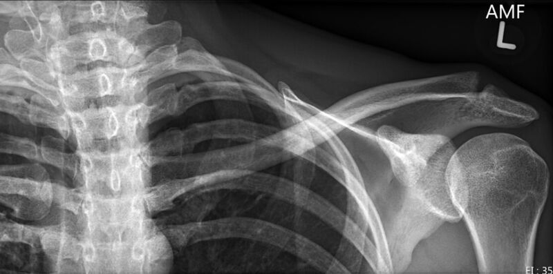 File:Distal clavicle osteolysis.jpg