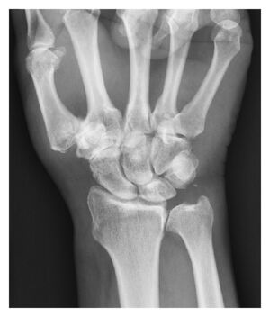 Xray STT joint osteoarthritis.jpg