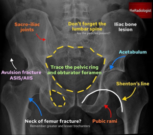 Pelvic Xray Review Areas.PNG