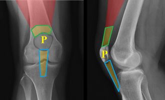 Figure 1: An annotated x-ray of the knee, showing patella (P) with the quadriceps muscle in red. The infrapatellar ligament (also known as the patellar tendon) is outlined in blue and the quadriceps tendon is outlined in green.