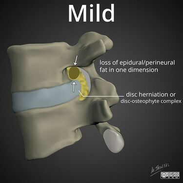 Mild: partial loss of perineural fat signal