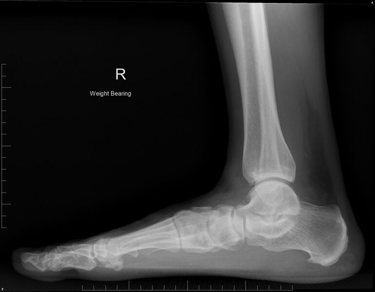 File:AAFFD xray lateral.jpg