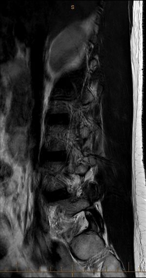 MRI T2 Lumbar Spine Sagittal Tangential.jpg