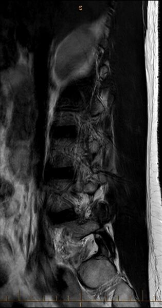 File:MRI T2 Lumbar Spine Sagittal Tangential.jpg