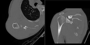 Figure 5: Axial and sagittal computed tomography (CT) images of same shoulder in Figure 4 showing an intact glenoid, but significant displacement and comminution of the fracture.