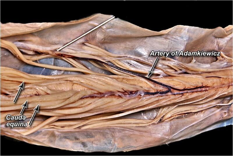 File:Cadaveric-dissection-of-the-artery-of-Adamkiewicz.jpeg