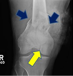 Figure 3: An x-ray of the distal femur, showing fracture of the medial and lateral femoral shaft, at the junction of the diaphysis and metaphysis (blue arrows). The fracture line continues distally and reaches the joint at the intercondylar notch (yellow arrow). (Figure courtesy of Christopher M. Domes, MD)