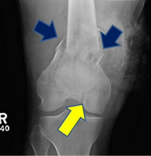 File:Distal femur fracture.jpg